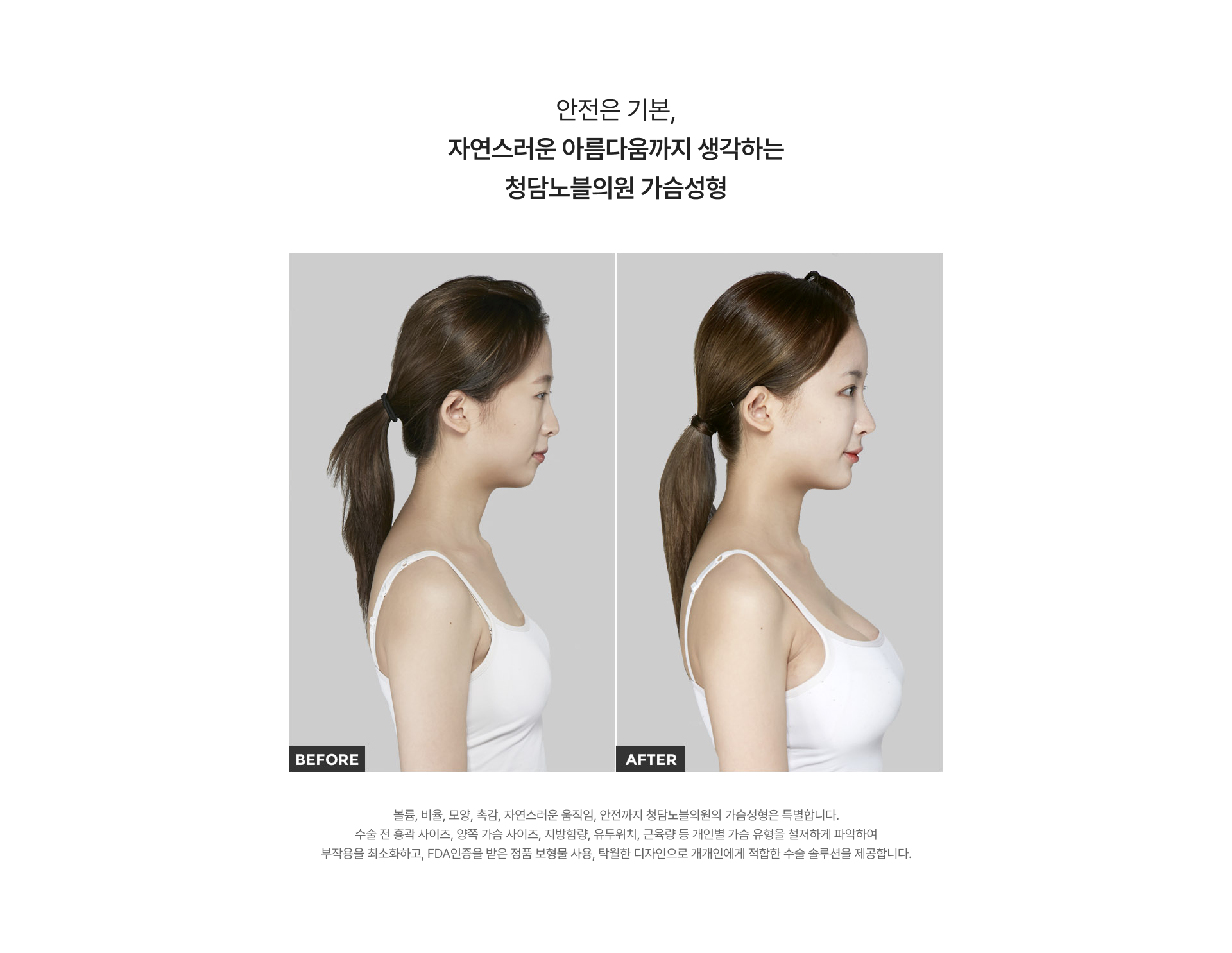 가슴성형 전과 후 측면 비교