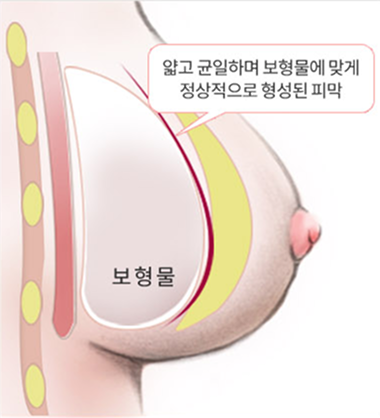 수술 후 정상적인 가슴의 상태