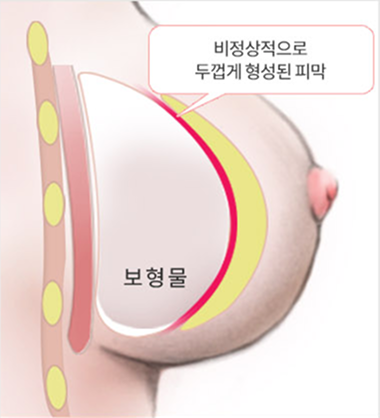 구형구축이 발생한 가슴의 상태
