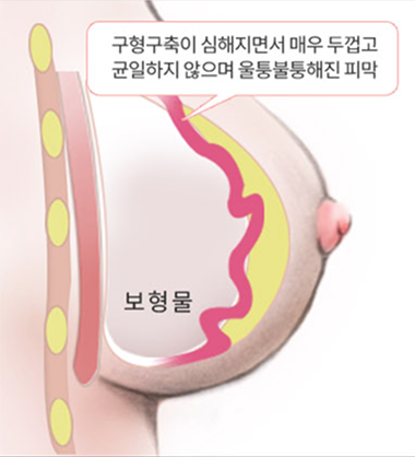 심한 구형구축이 발생한 가슴의 상태