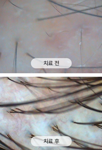 치료 전 두피