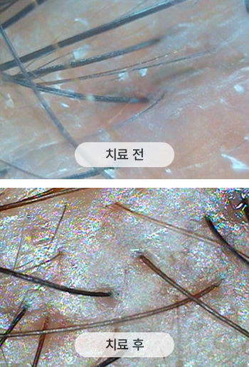 치료 전 두피