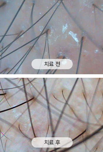 치료 전 두피