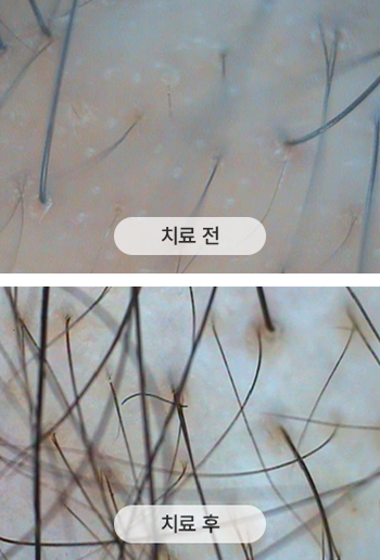 치료 전 두피