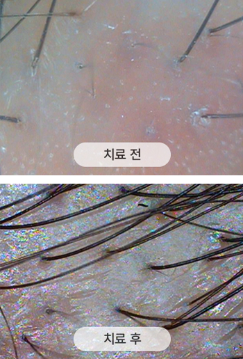 치료 전 두피