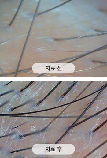 치료 전 두피