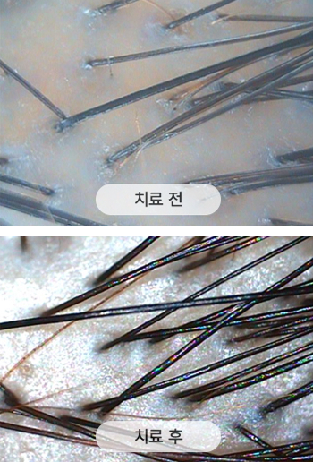 치료 전 두피