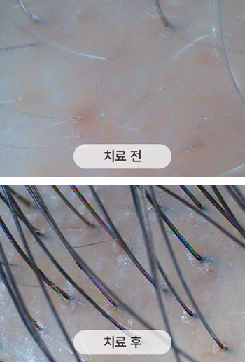치료 전 두피