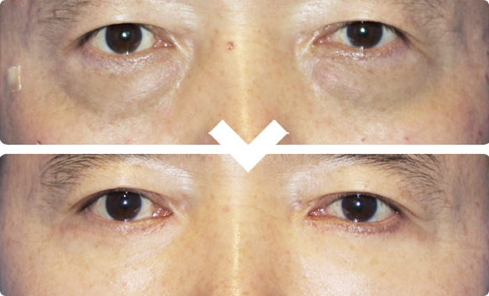 50대 남성 하안검 수술 전과 수술 후 1개월 비교
