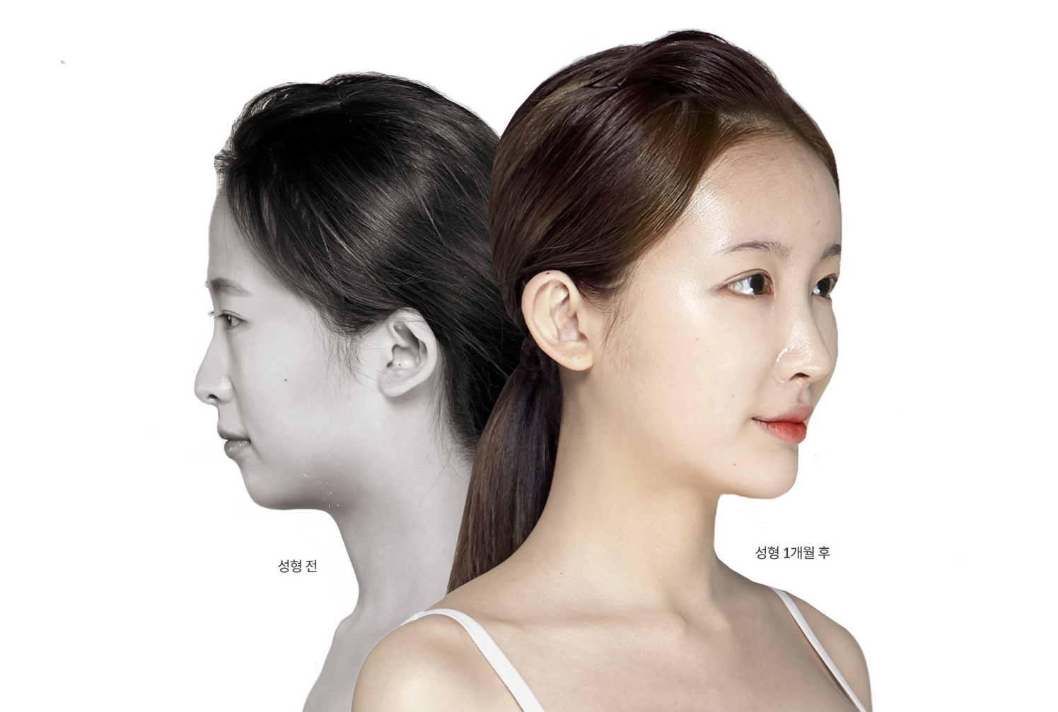 코성형 전과 성형 1개월 후 옆모습 비교