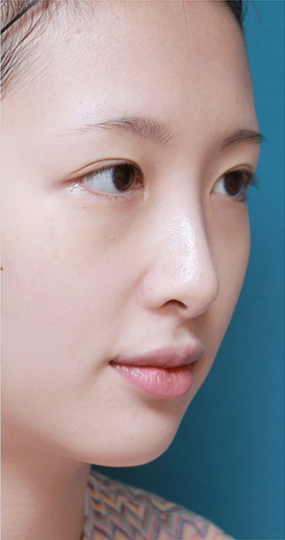 눈수술과 코수술 수술 전 모습