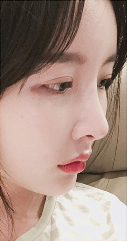 눈수술과 코수술 1개월 후 모습