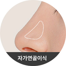 자가연골이식