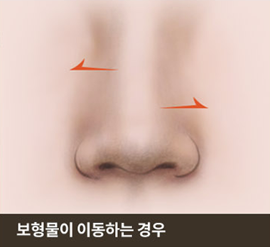 보형물이 이동하는 경우