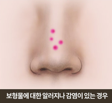 보형물에 대한 알러지나 감염이 있는 경우