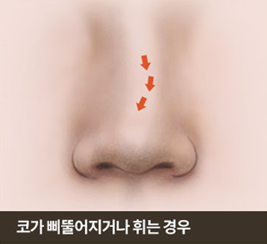 코가 삐뚤어지거나 휘는 경우