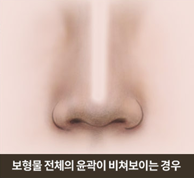 보형물 전체의 윤곽이 비쳐보이는 경우