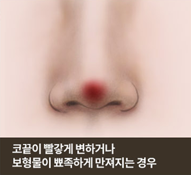 코끝이 빨갛게 변하거나 보형물이 뾰족하게 만져지는 경우