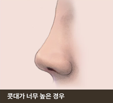콧대가 너무 높은 경우