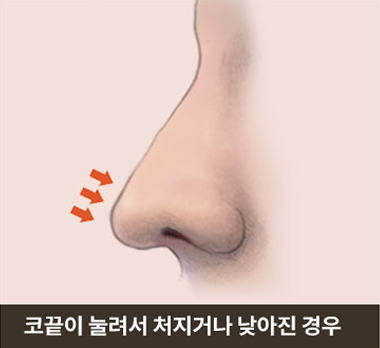 코끝이 눌려서 처지거나 낮아진 경우