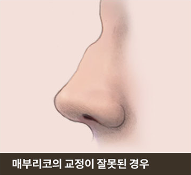 매부리코의 교정이 잘못된 경우